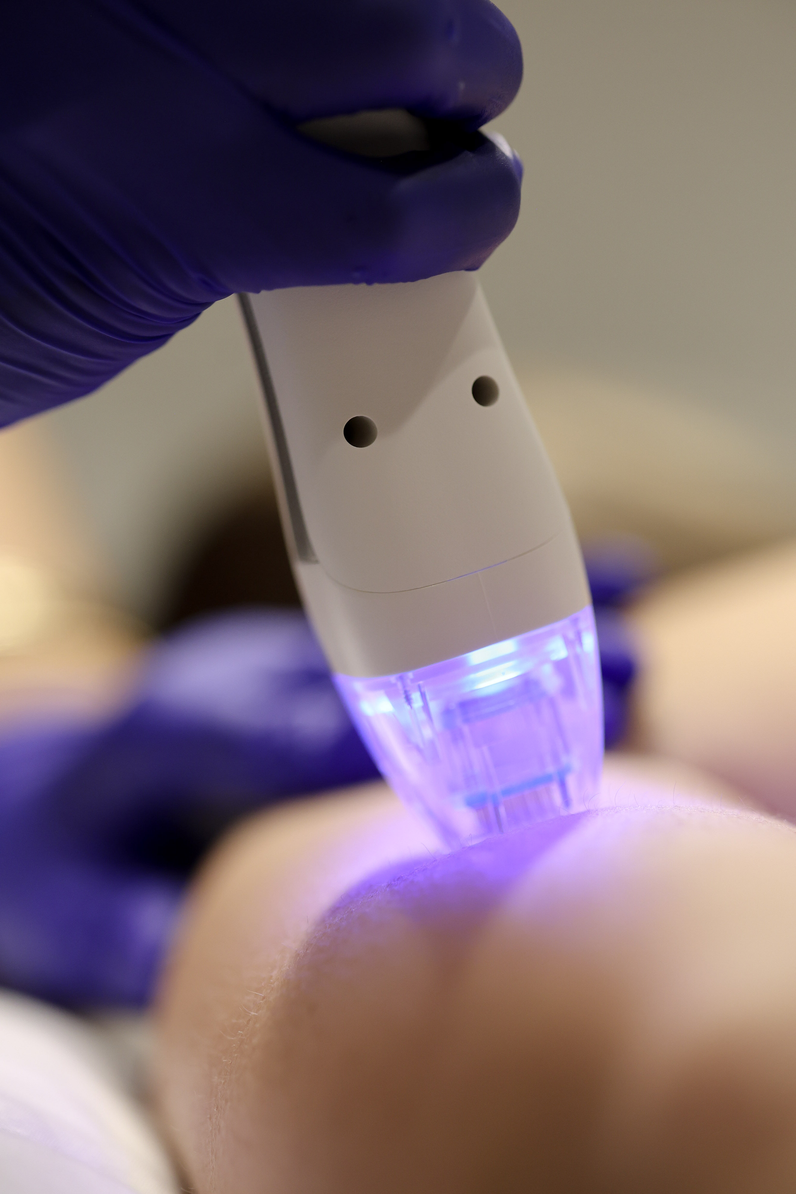 VirtueRF RF microneedling treatment