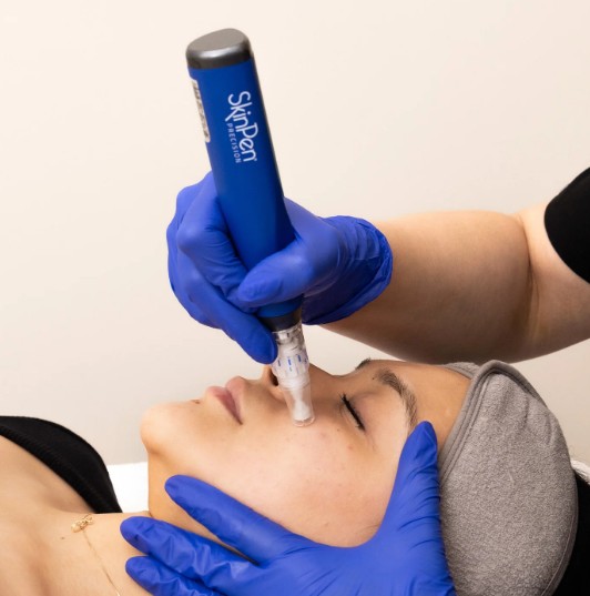 SkinPen microneedling treatment